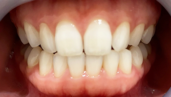 ジェル塗布の様子