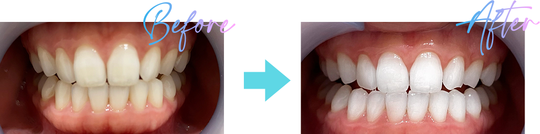 ホワイトニング Bコース